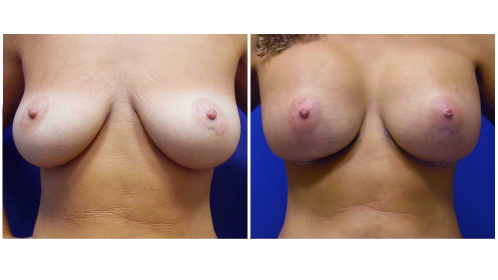 Fat Transfer Breast Augmentation Patient (32Years)